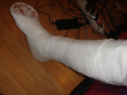 Покалеченную ногу пострадавшего в страшном ДТП парня ампутировали в Новочеркасске