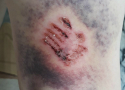 Агрессивные бродячие собаки покусали женщину в микрорайоне Донском Новочеркасска