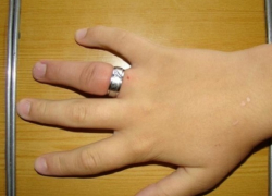 Для того, чтобы снять с пальца кольцо, жительнице Новочеркасска пришлось вызывать спасателей