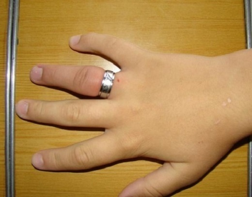 Для того, чтобы снять с пальца кольцо, жительнице Новочеркасска пришлось вызывать спасателей
